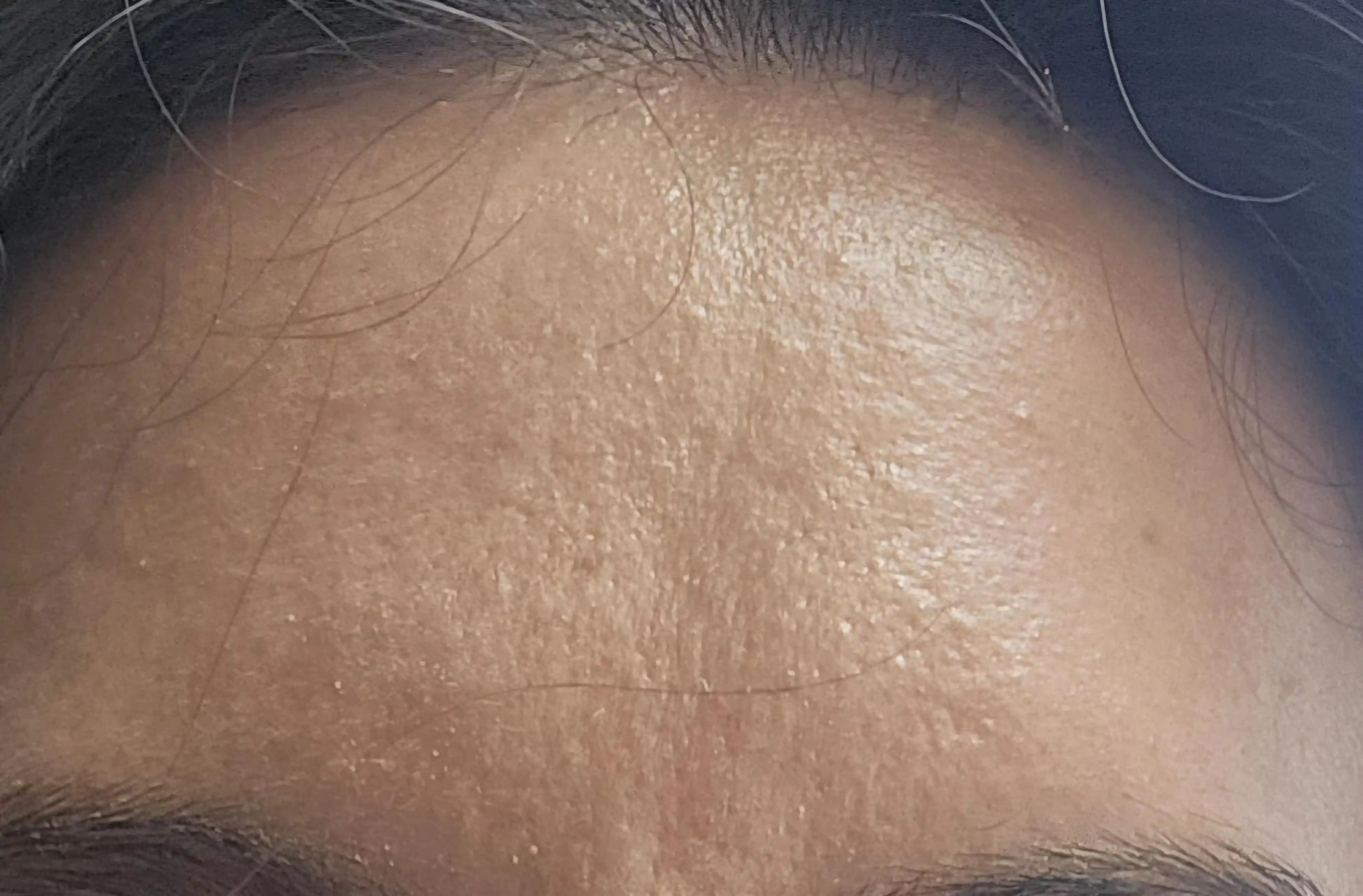 Alında Sürekli Bulanıklık ve Pürüzlülüğün Nedenleri ve Etkili Tedavi Yöntemleri