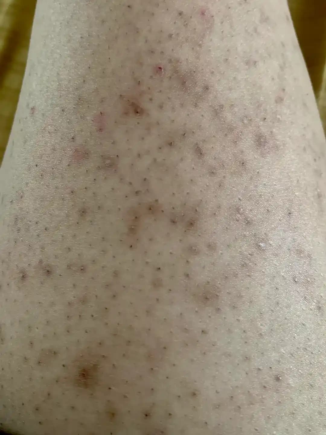 Bacaklardaki Batık Tüy Sorunları ve Etkili Tedavi Yöntemleri Hakkında Bilgi