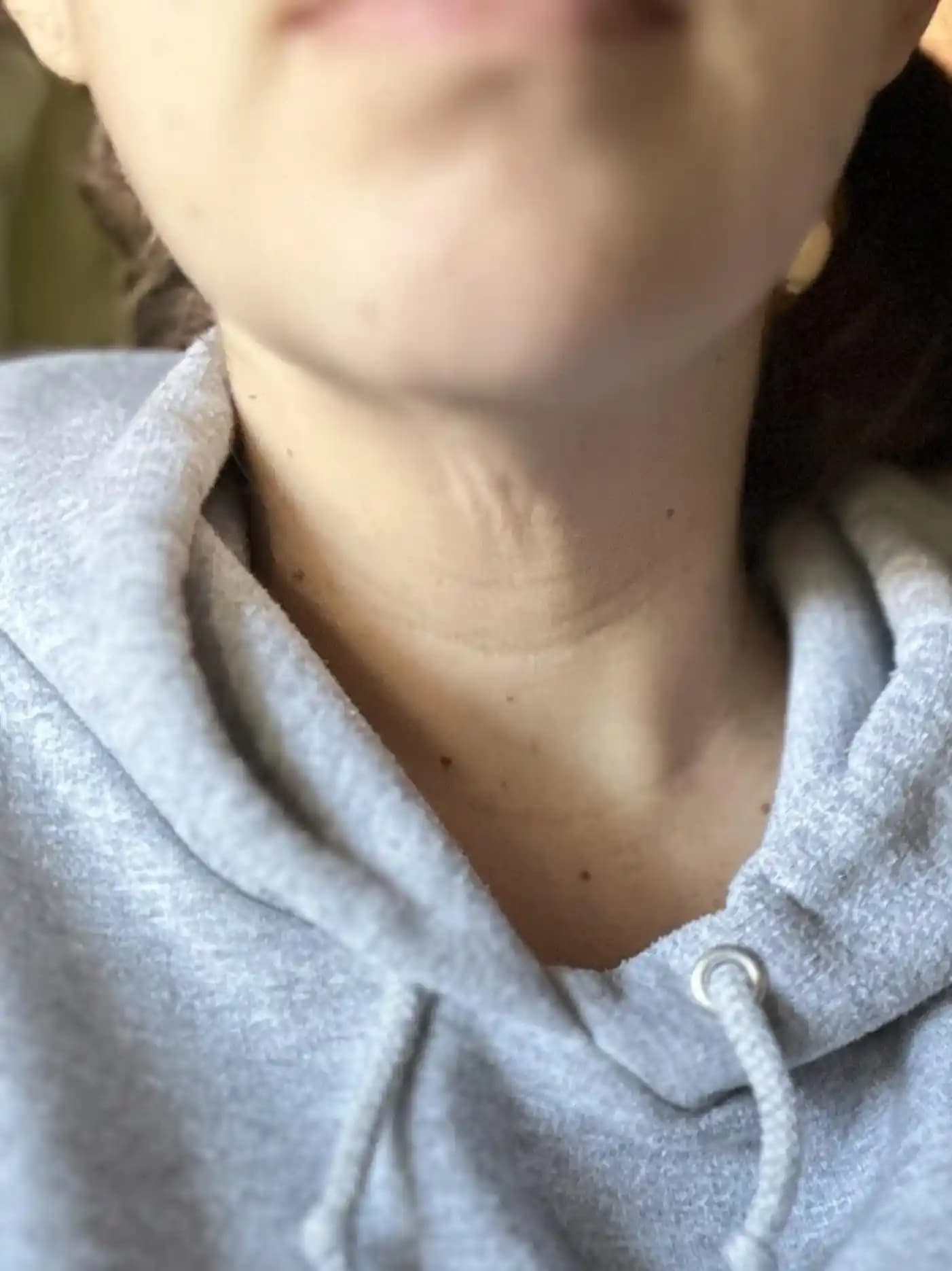 Çene Altı Kırışıklıkları: Nedenleri, Önleme Yöntemleri ve Tedavi Seçenekleri