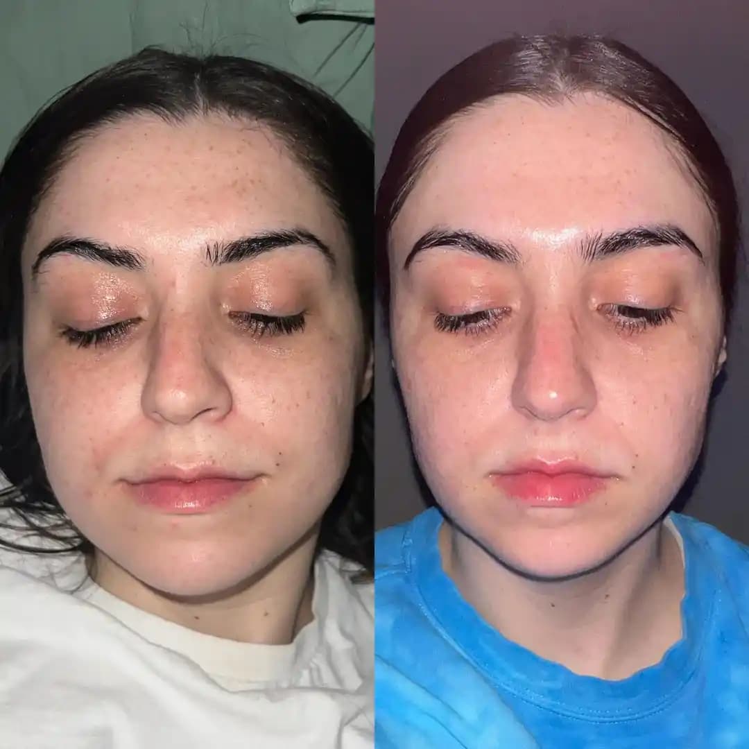 CurrentBody Multi Light LED Maske ile 90 Günlük Düzenli Kullanımın Cilt Bakımına Etkileri