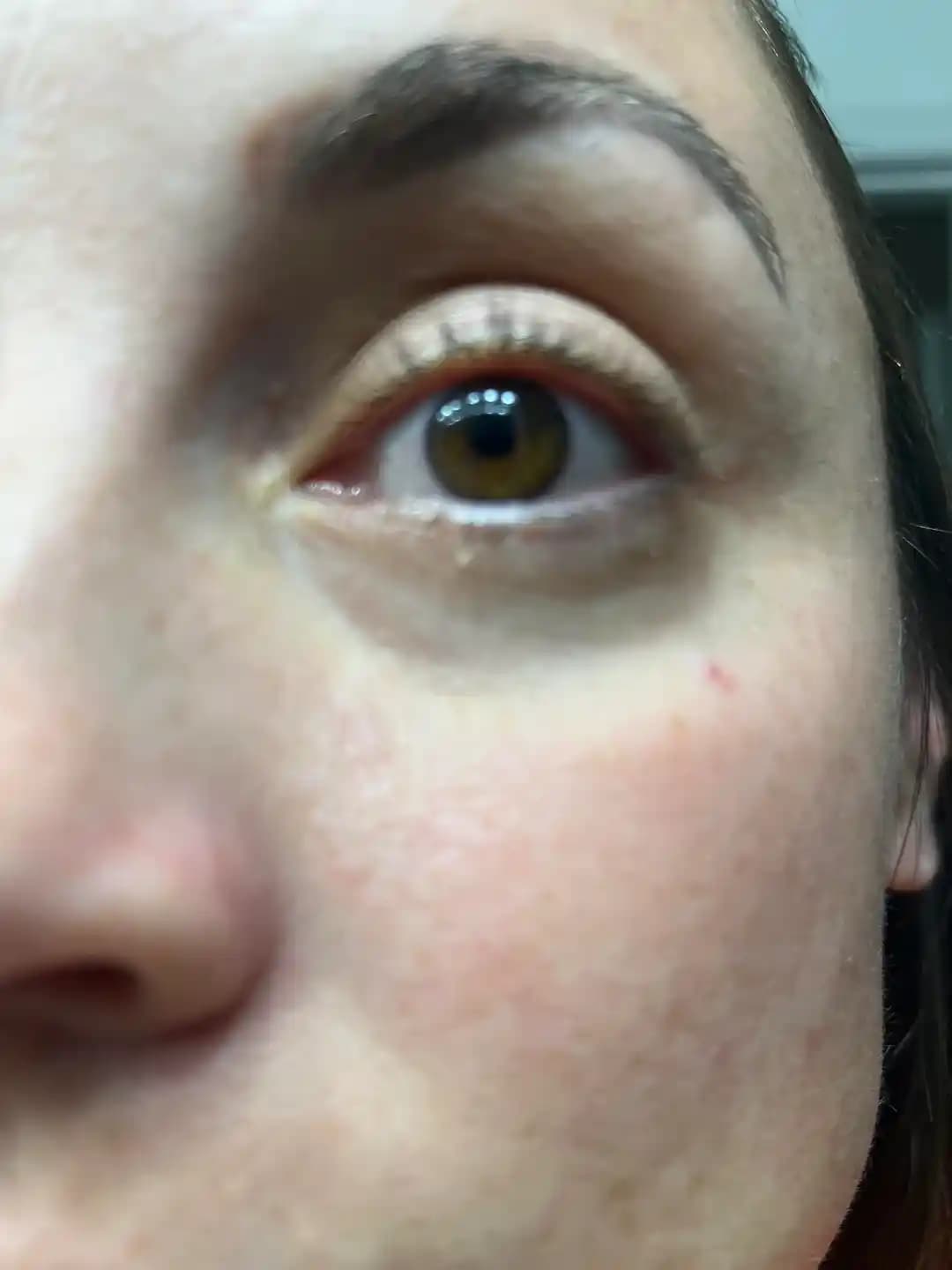 Göz Altındaki Beyaz Noktalar: Milia Nedir ve Etkili Tedavi Yöntemleri