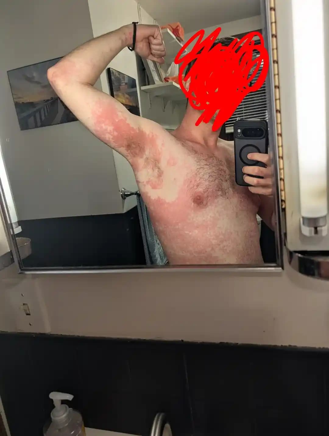 Vücut Yıkama Ürünlerinde Tam Vücut Alerjik Reaksiyonların Nedenleri ve Önlemleri