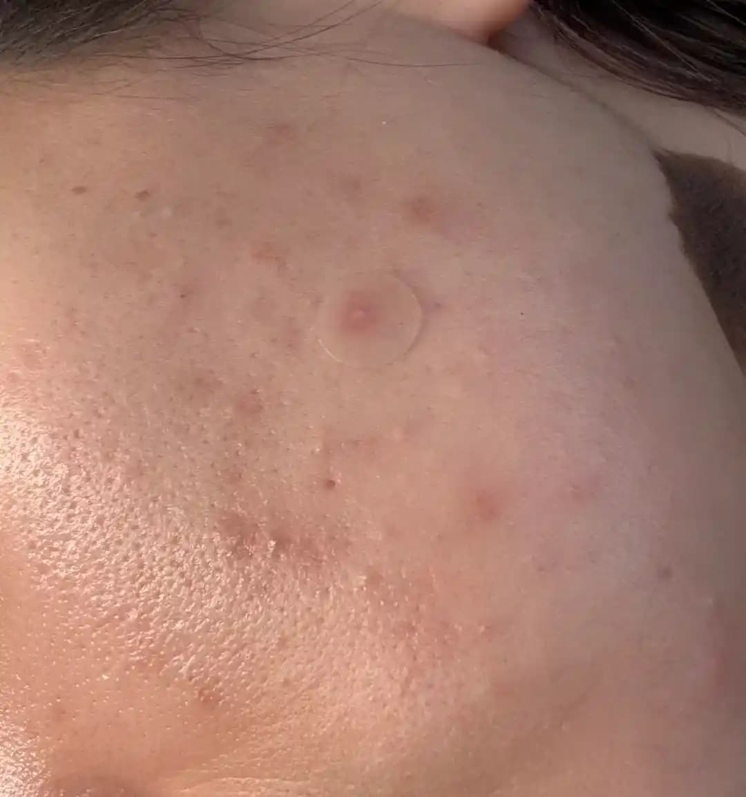 Yüzde Geçmeyen Kabarcıkların Nedenleri ve Etkili Tedavi Yöntemleri