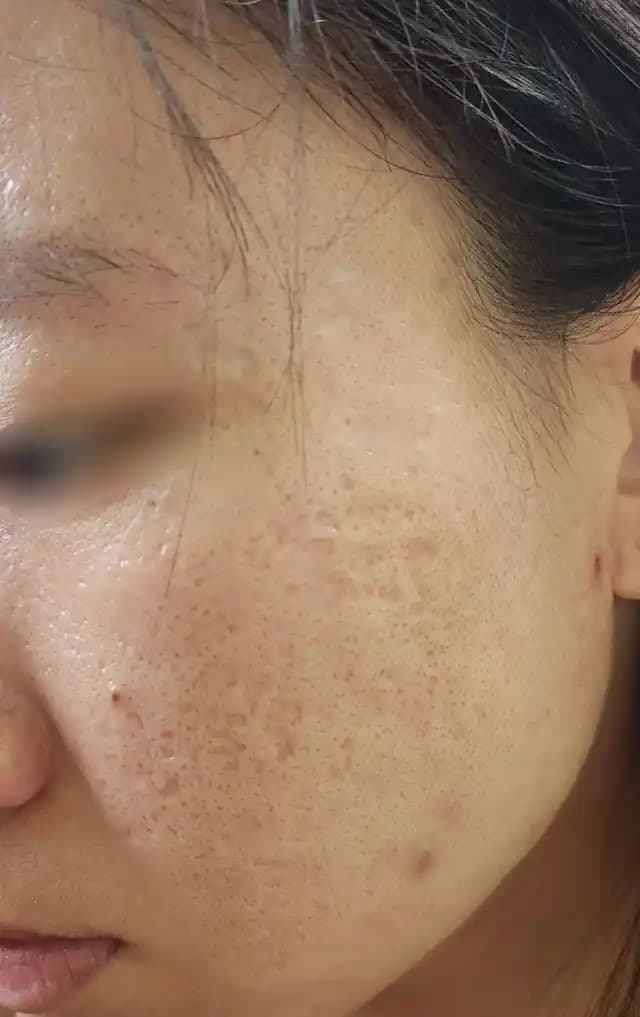 Akne İzleri İçin Mikroneedling ve CO2 Fraksiyonel Lazer Tedavi Yöntemleri ve Cilt Bakımı