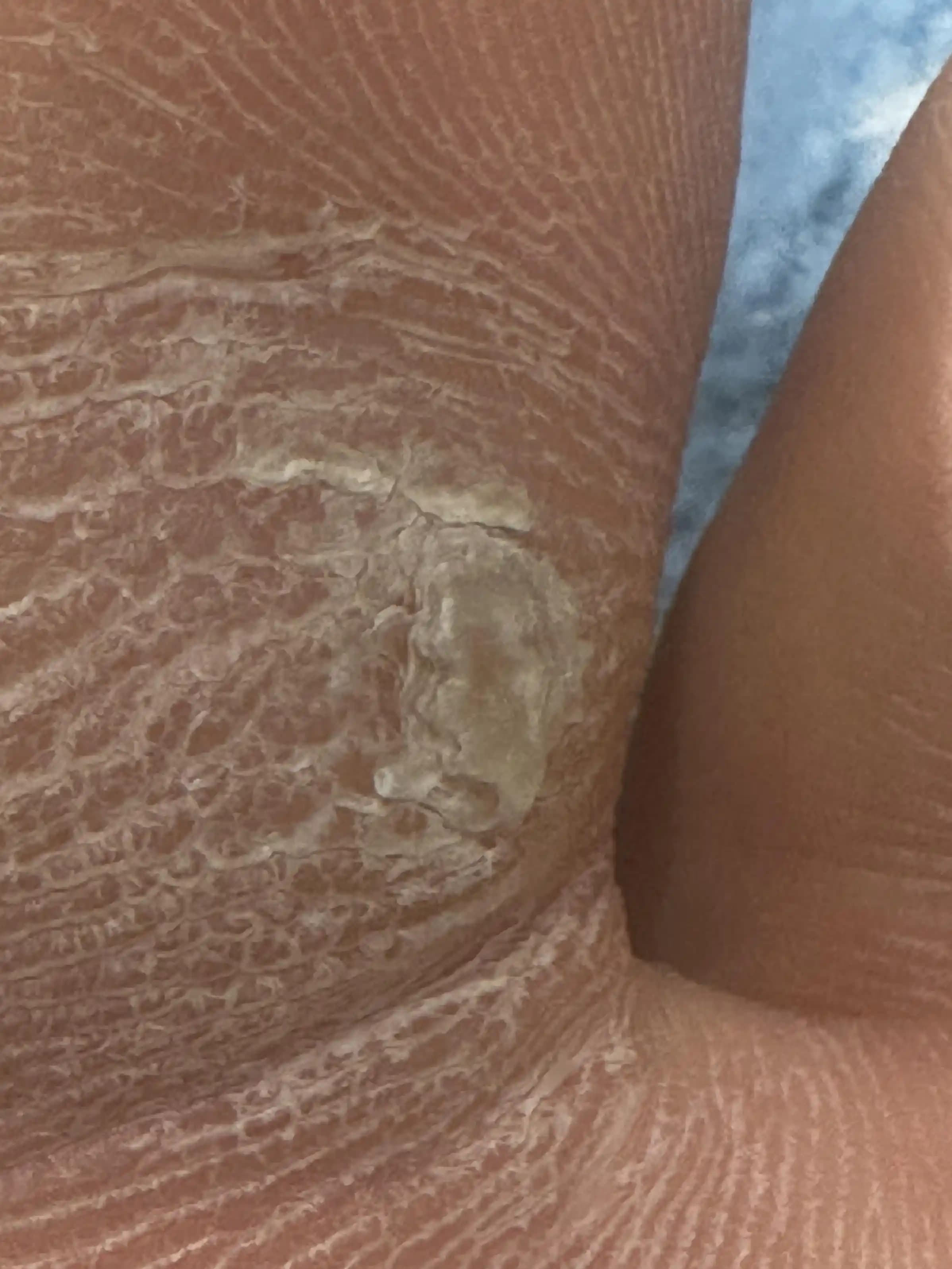 Ayaklardaki Nasır ve Sertleşmiş Derinin Etkili Tedavi ve Bakım Yöntemleri