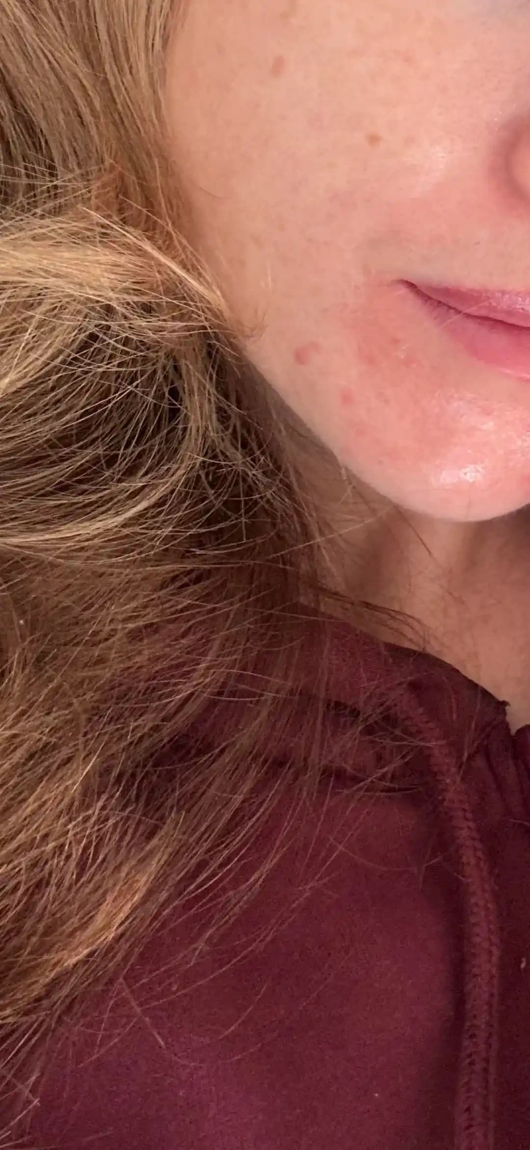 Azelaik Asit ile Hormonal Akne Tedavisinde Purging ve İrritasyonun Yönetimi