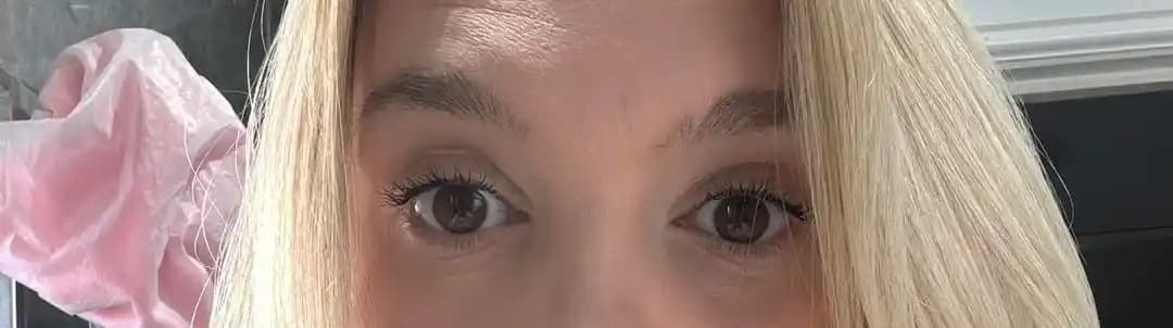 Botox Sonrası Kaş Düşmesi: Nedenleri, Süresi ve Tedavi Yöntemleri Hakkında Bilgi