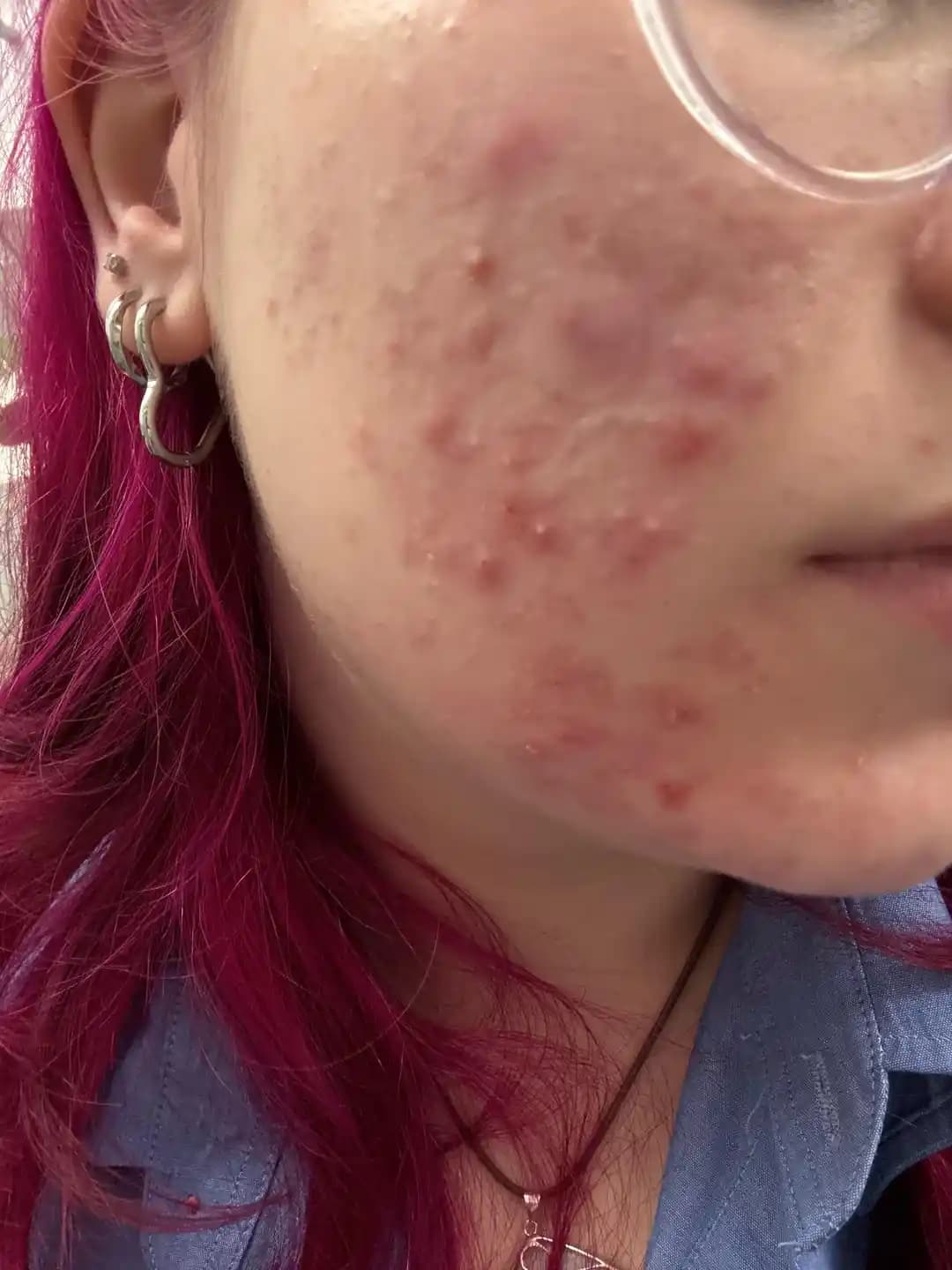 Differin Kullanımının 8. Haftasında Ciltteki Değişiklikler ve Bakım Yöntemleri