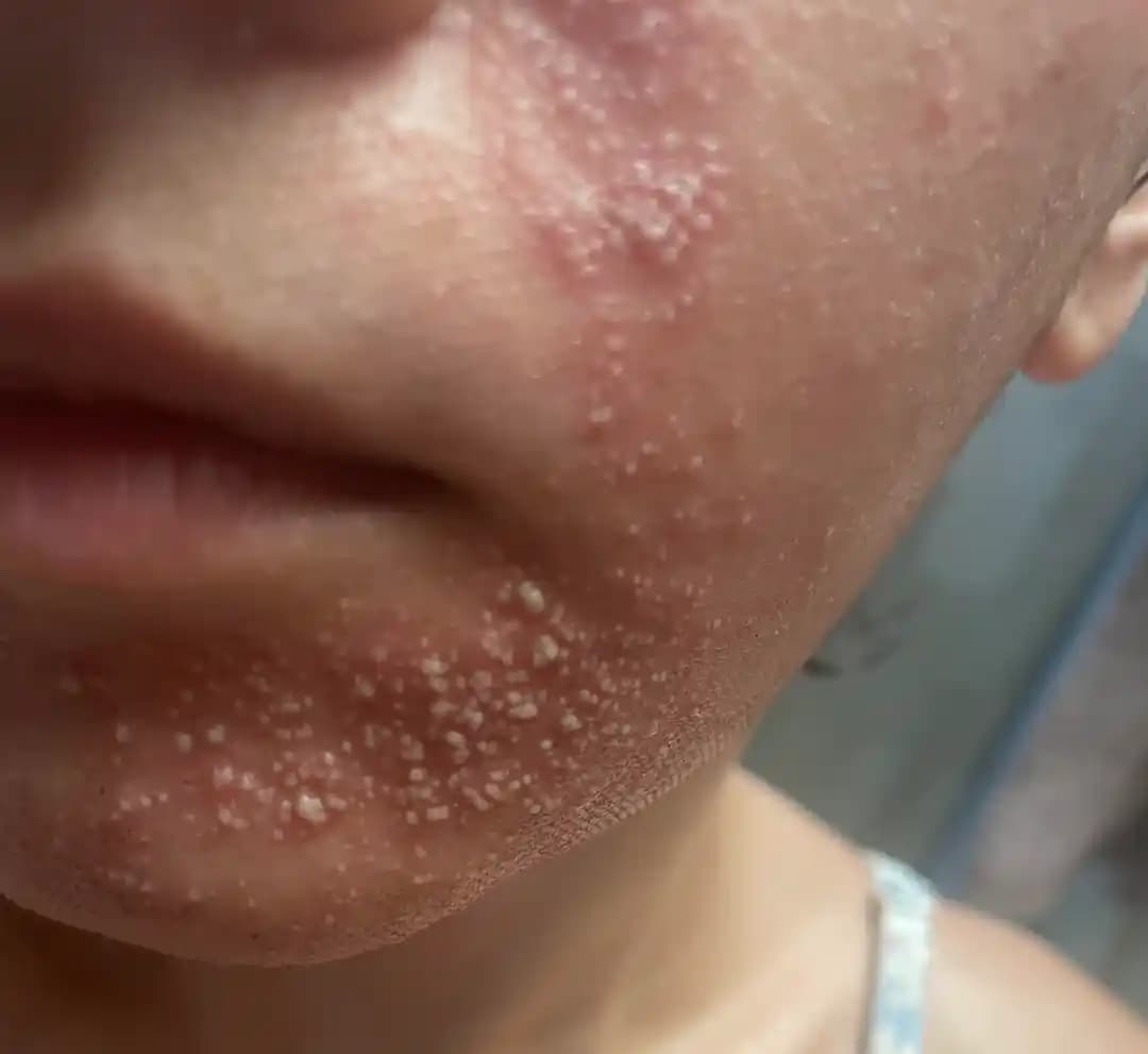 Fraksiyonel CO2 Lazer Tedavisinde Reaksiyonlar, İyileşme Süreci ve Bakım Önerileri