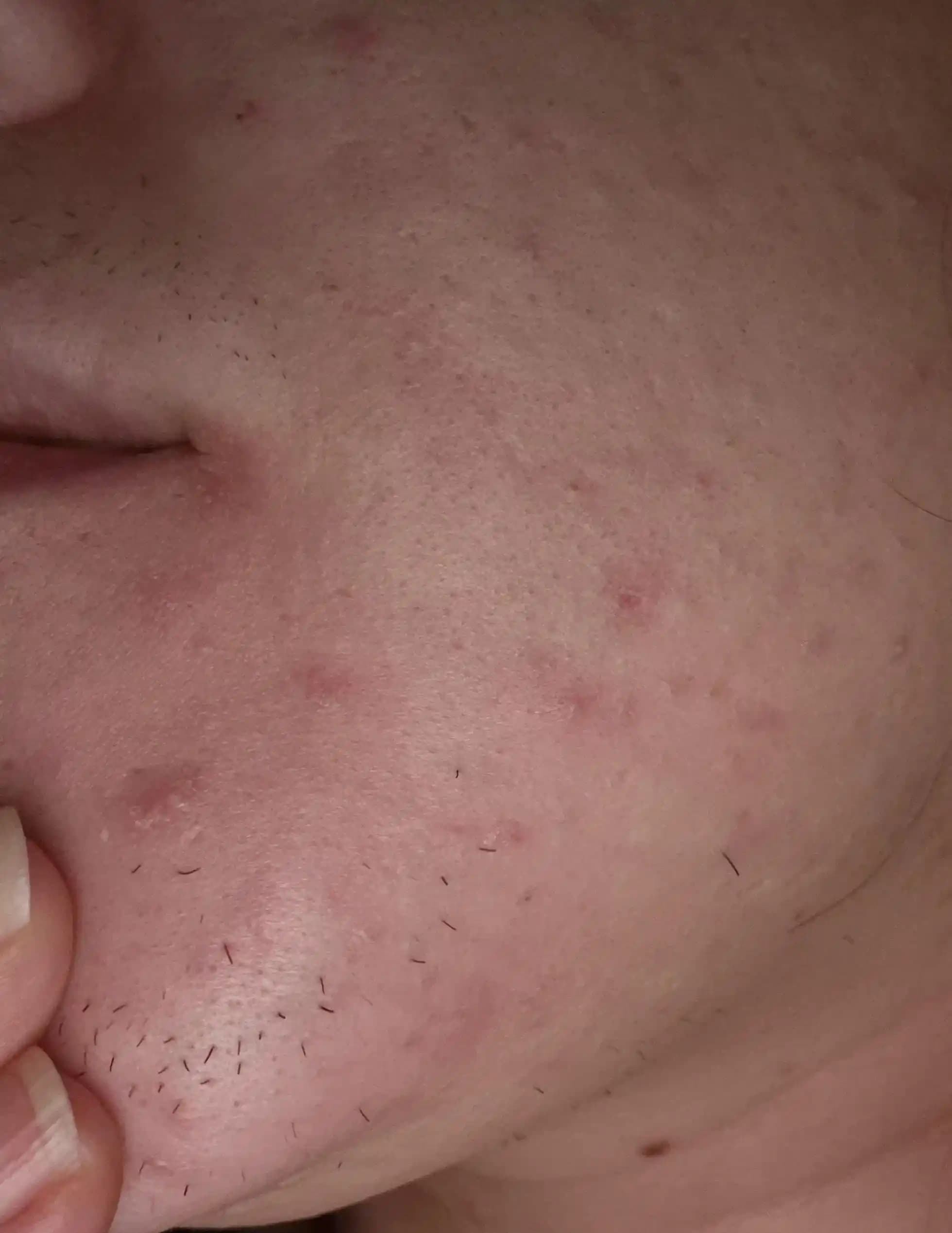 Hirutizm ve Ciltte Oluşan Nodüller: Nedenler, Tedavi Yöntemleri ve Cilt Bakımı