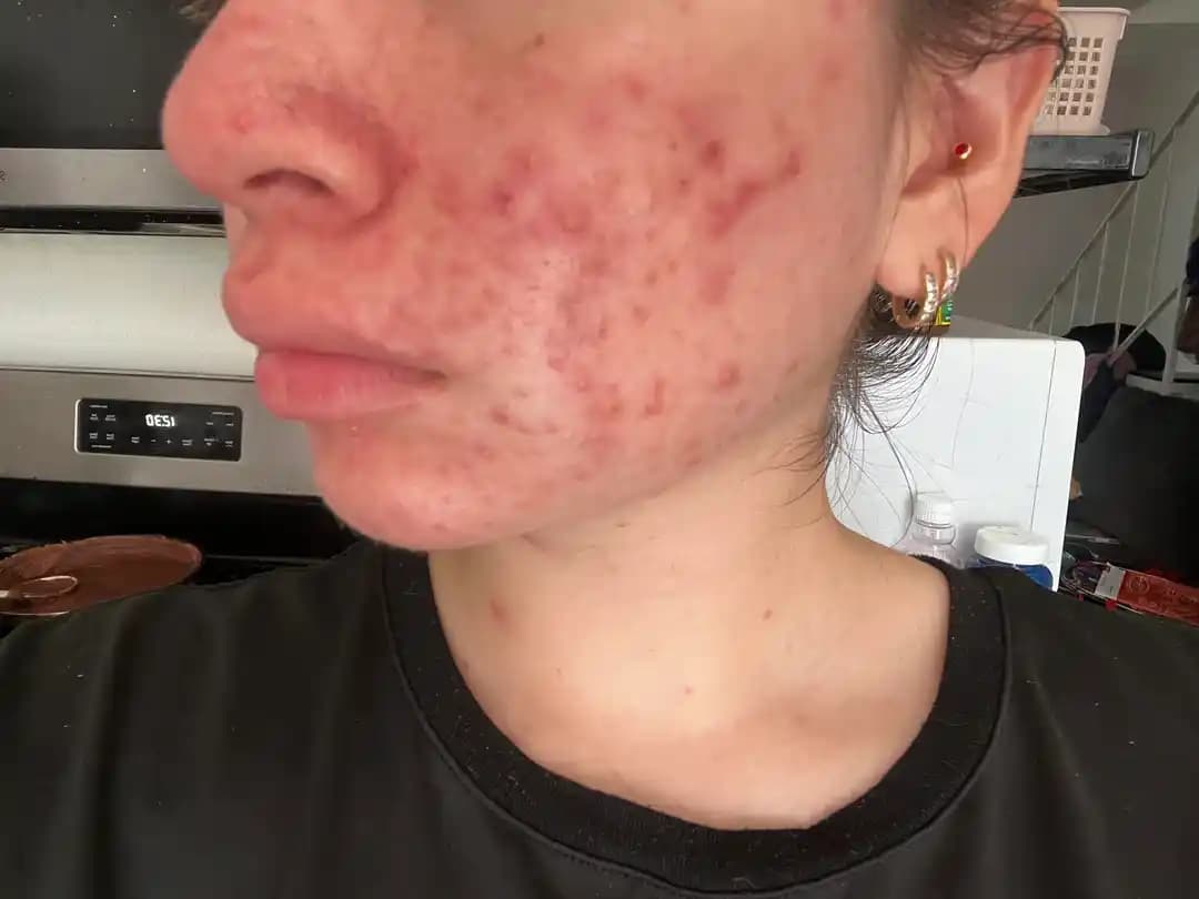 Hormonal Akne Nedenleri, Tedavi Yöntemleri ve Cilt Bakımında Doğru Yaklaşımlar