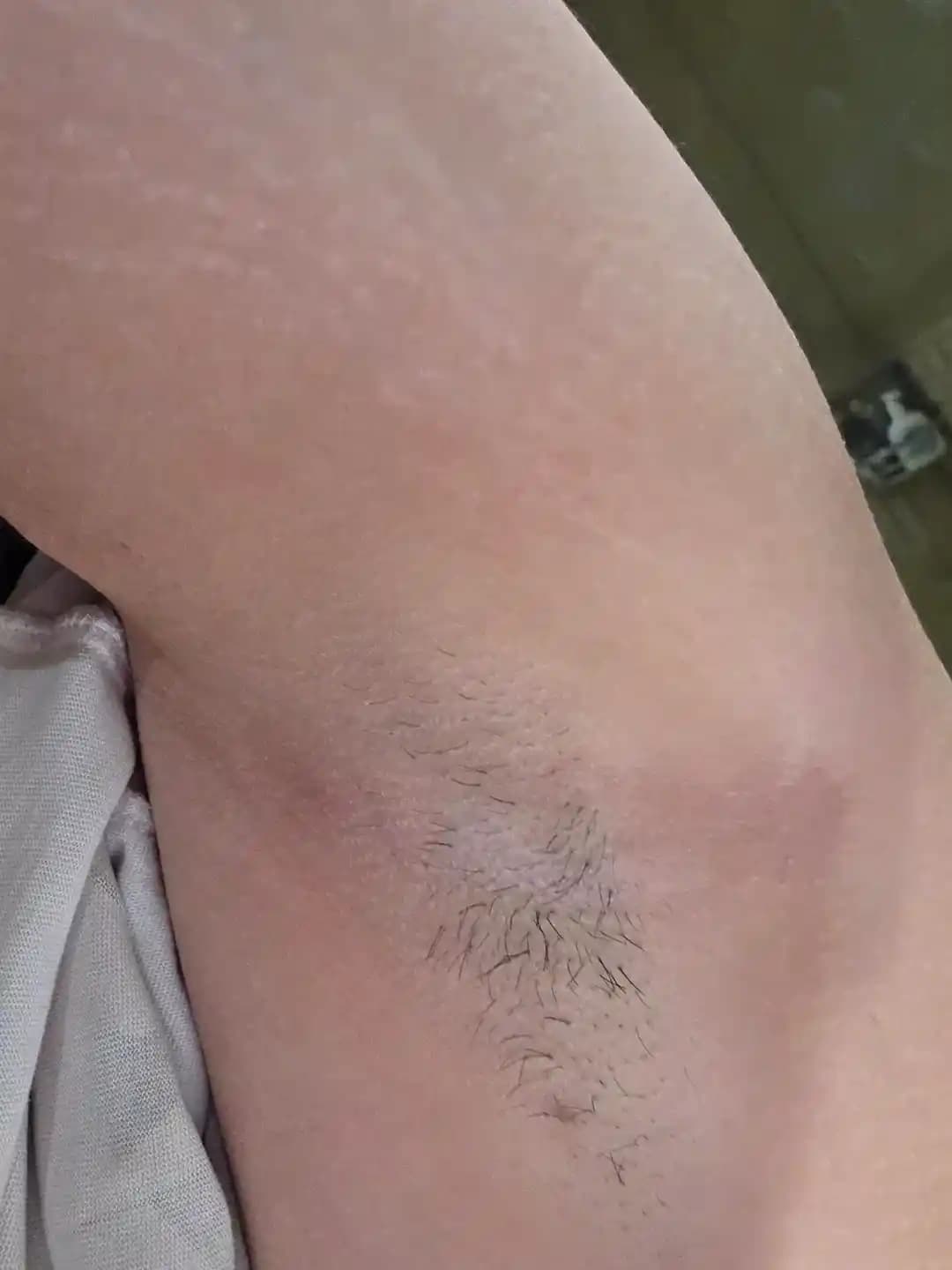 Kol Altındaki Morarma ve Koyu Renklenmenin Nedenleri, Tedavi ve Önleme Yöntemleri