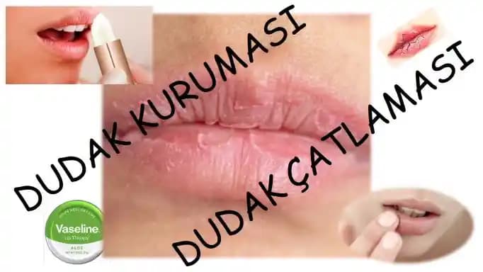 Kronik Dudak Kuruluğu ve Çatlaklarının Nedenleri ile Etkili Tedavi Yöntemleri