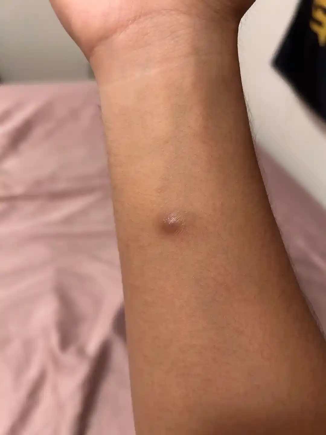 Sert Kabarcık ve Sivilce Arasındaki Farklar ve Dermatoloğa Başvuru Zamanları