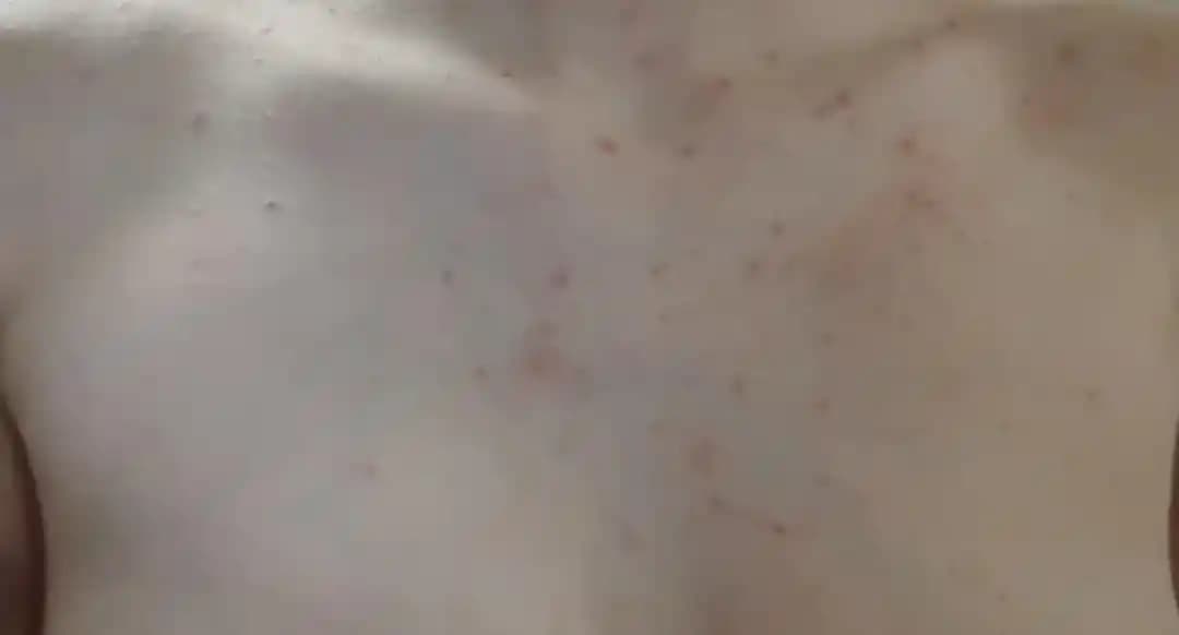 Vücut Sivilceleri: Nedenleri, Tedavi Yöntemleri ve Etkili Bakım Önerileri