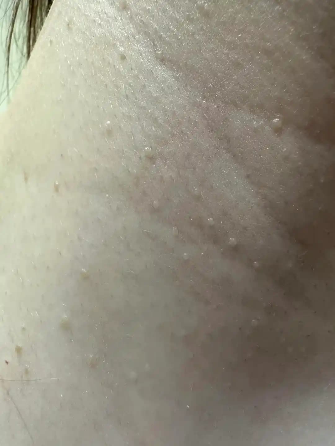 Vücutta Yaygın Kabarcıkların Seboreik Dermatit ve Diğer Nedenleri Üzerine Klinik Değerlendirme