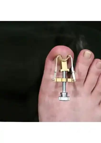 Batık Tırnak Düzeltme Aletiyle Tırnak Sağlığını Koruma ve Estetik Çözüm