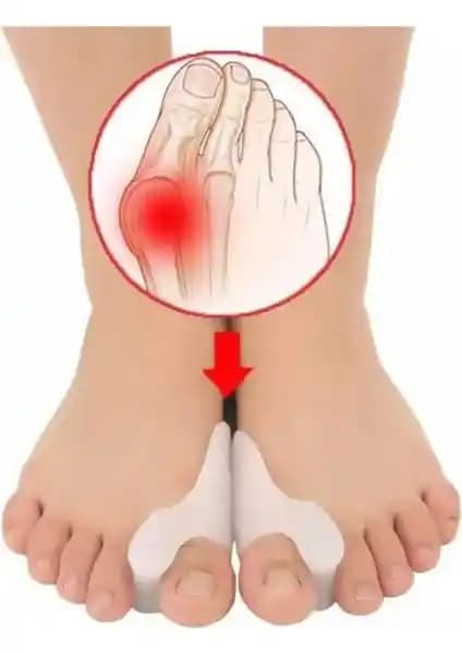 Sanal Trend Bay Bayan Parmak Arası Ayak Bunyon Kemik Koruyucu Silikon Tasarımı ve Faydaları