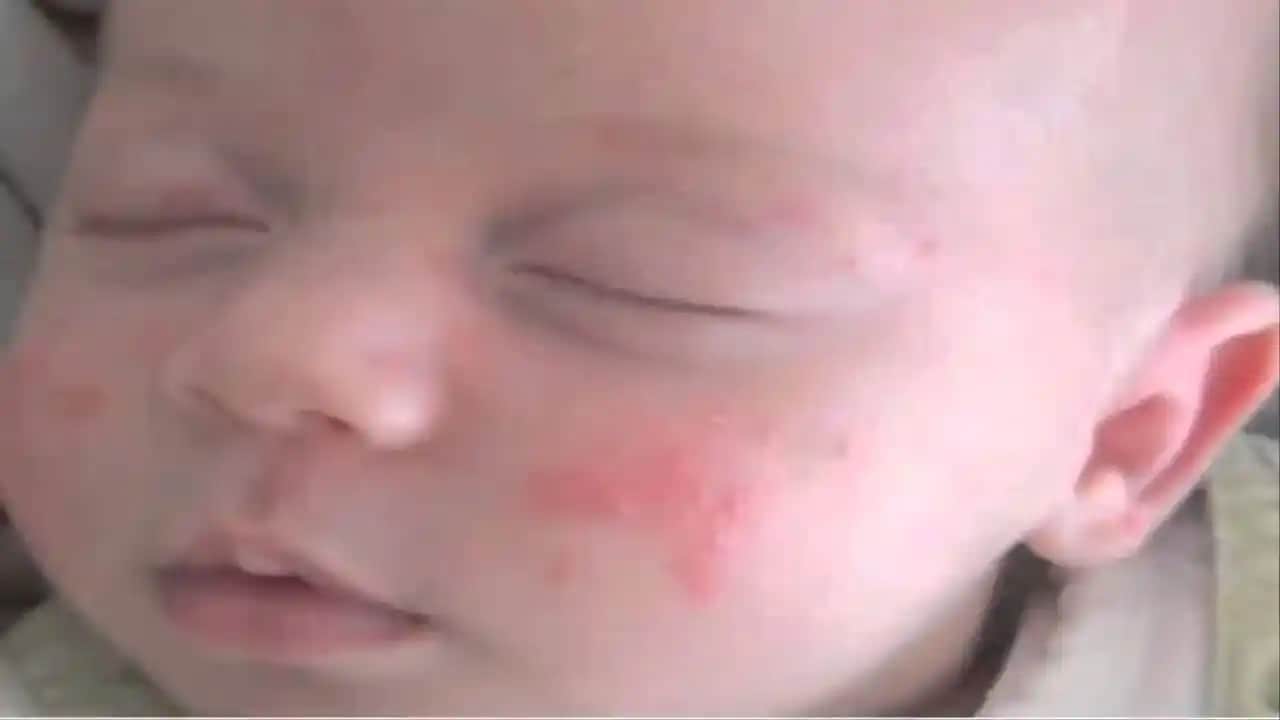 1 Yaşındaki Bebeklerde Sivilce Nedenleri ve Uygun Bakım Yöntemleri