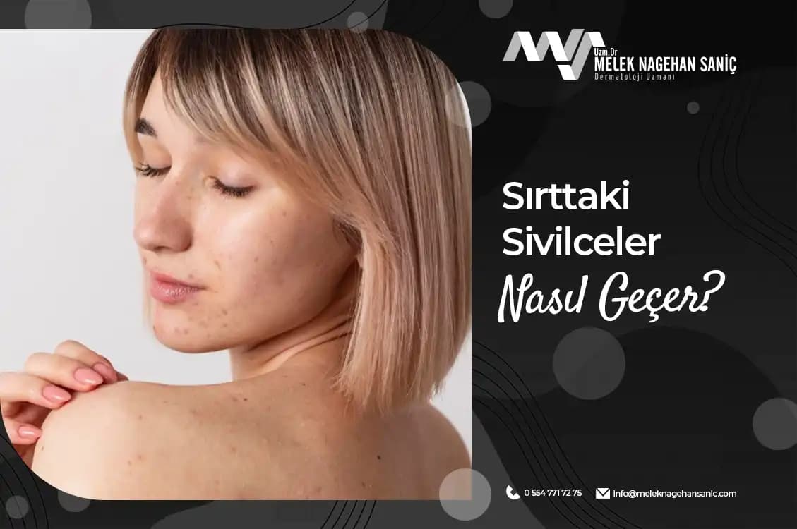 11 Yaşta Sivilcelerle Mücadele Yolları ve Ergenlik Döneminde Cilt Bakımı
