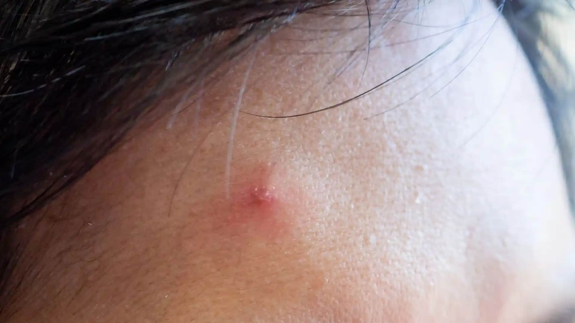 14 Yaşında Sivilce Nasıl Geçer: Gençlik Döneminde Cilt Bakımı ve Doğal Çözümler