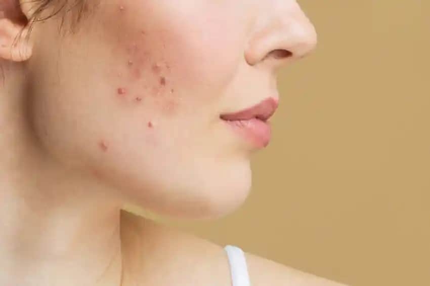 4 Ay Geçmeyen Sivilceler: Nedenleri, Çözümleri ve Cilt Bakımı İpuçları