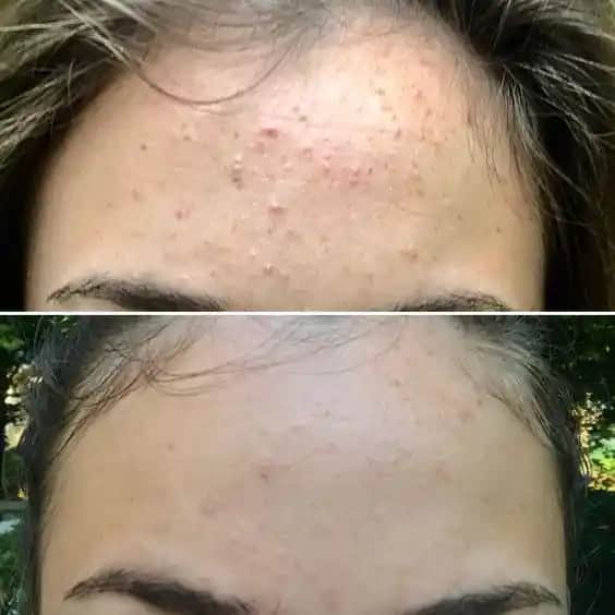 6 Yaşındaki Kız Çocuklarında Sivilce Nedenleri ve Etkili Çözüm Yöntemleri