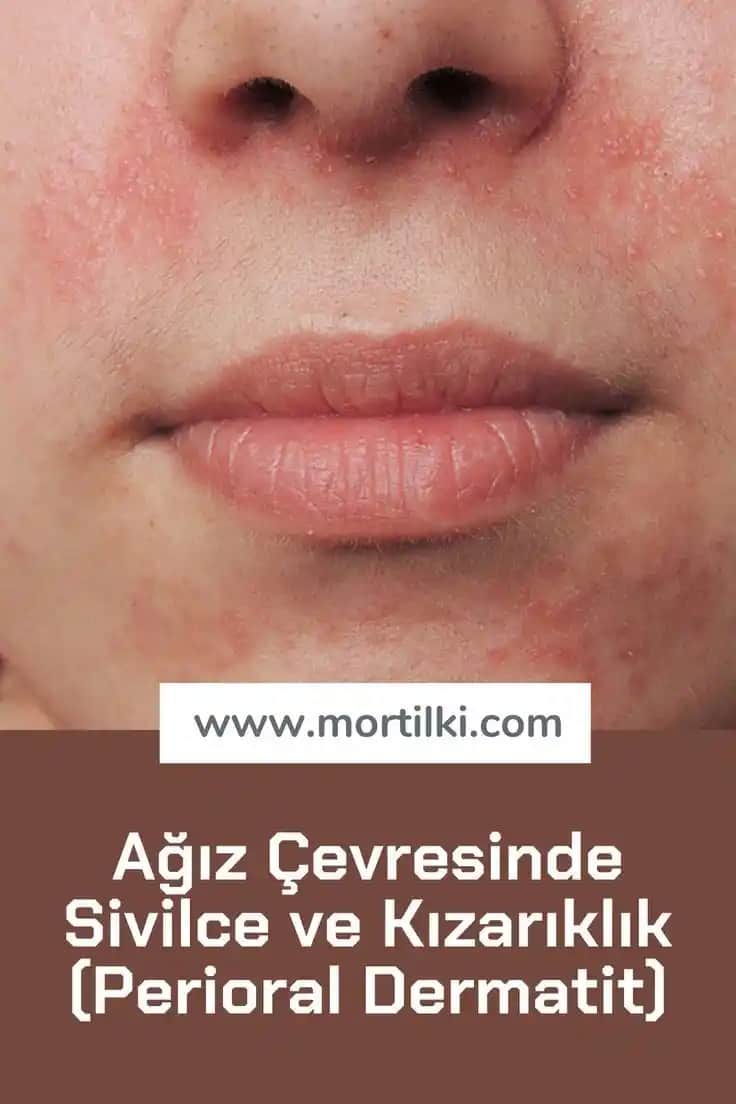 Ağız Etrafı Kızarıklığının Nedenleri, Belirtileri ve Etkili Çözüm Yolları