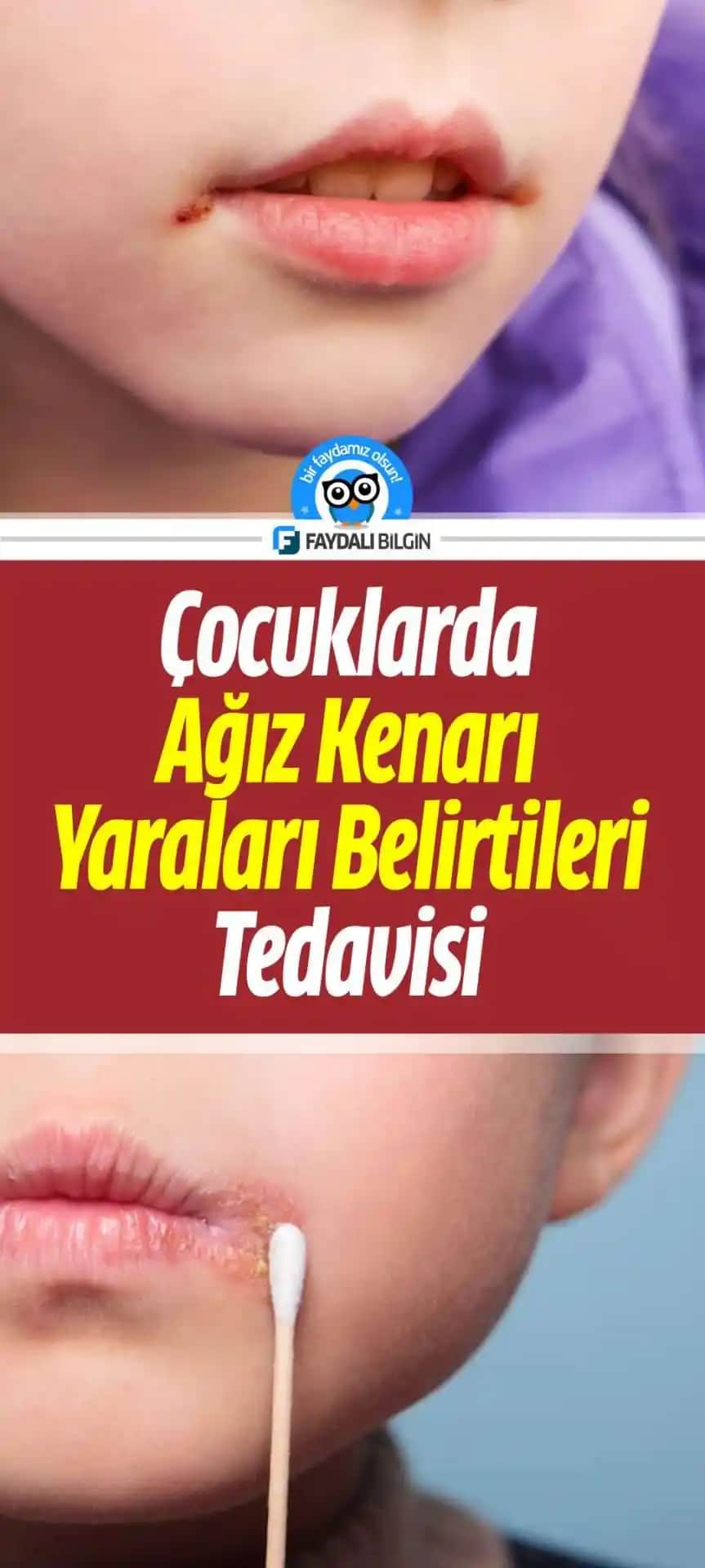 Ağız Kenarı Kararmaları Nedenleri ve Doğal ile Profesyonel Çözüm Yöntemleri