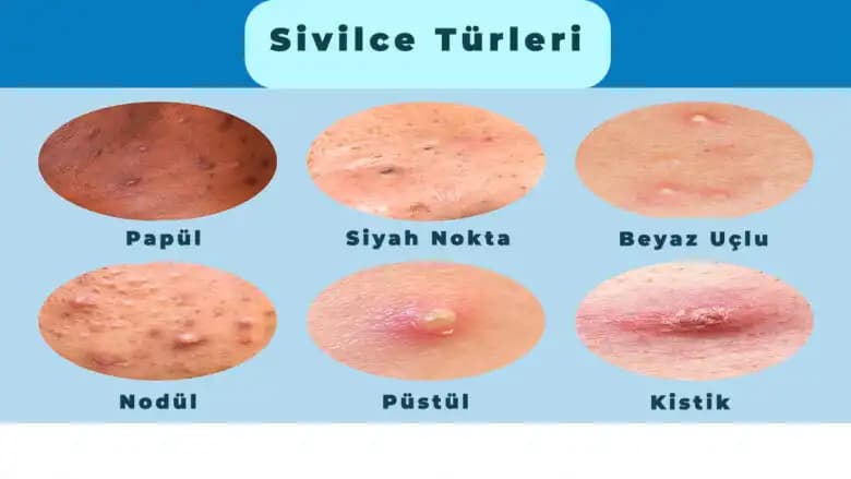 Akılı Sivilcenin Nedenleri ve Cilt Sağlığını Koruma Yöntemleri