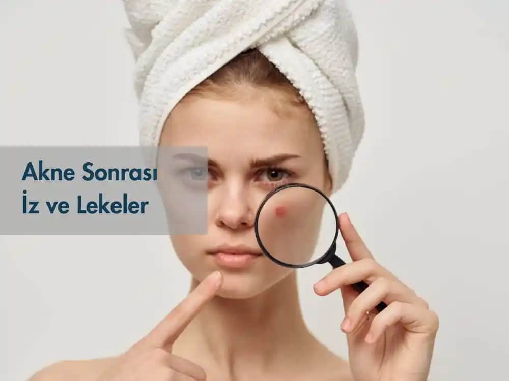 Akne Lekeleriyle Mücadele Yöntemleri ve Doğal Çözüm Tavsiyeleri