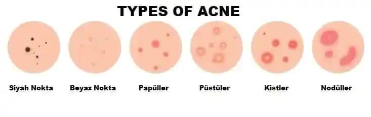 Akne Türleri ve Cilt Sağlığı Üzerindeki Etkileri Hakkında Detaylı Bilgi