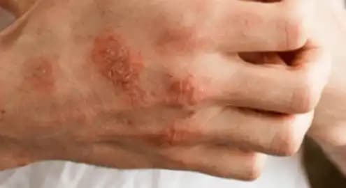 Alerjik Egzama Belirtileri ve Kozmetik ile Kontrol Yöntemleri Hakkında Kapsamlı Bilgi