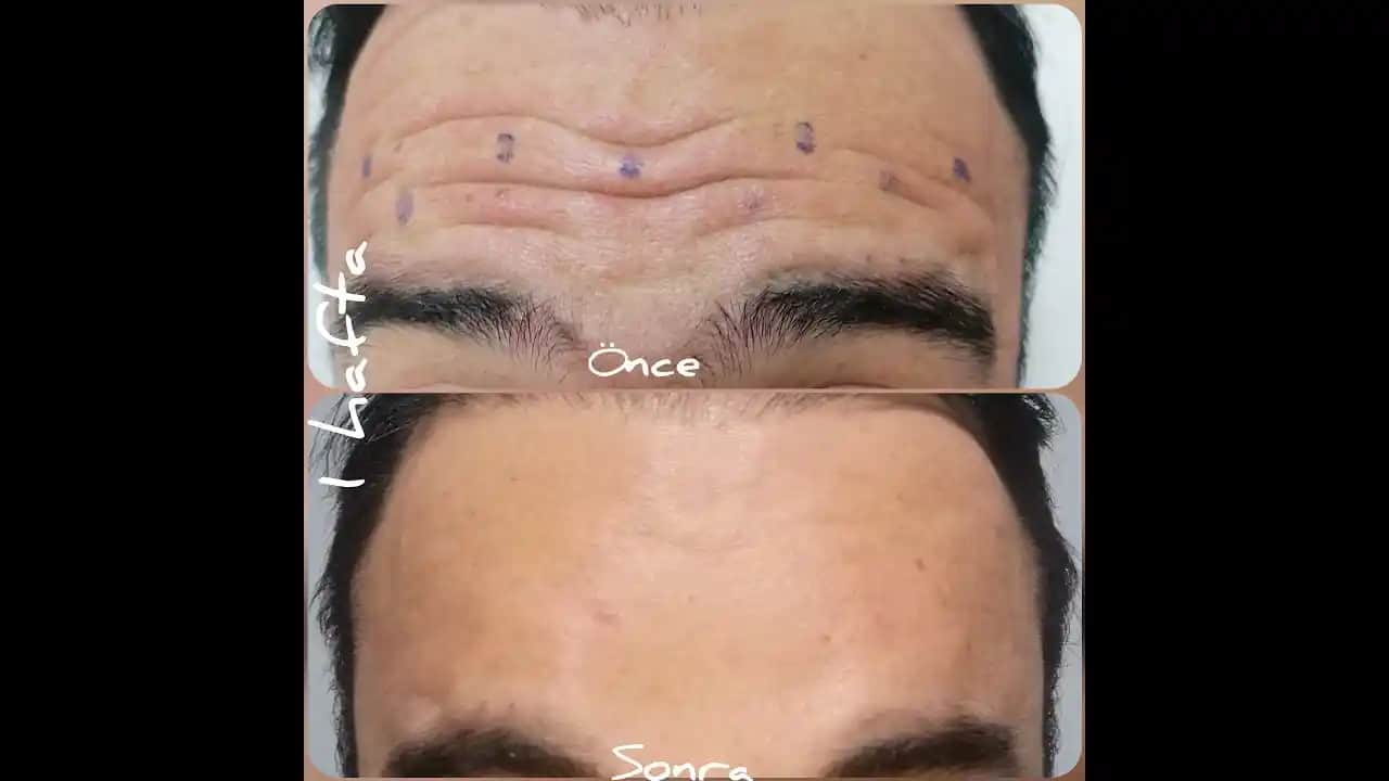 Alın Çizgilerini Azaltma Yolları: Doğal ve Profesyonel Çözümler Rehberi