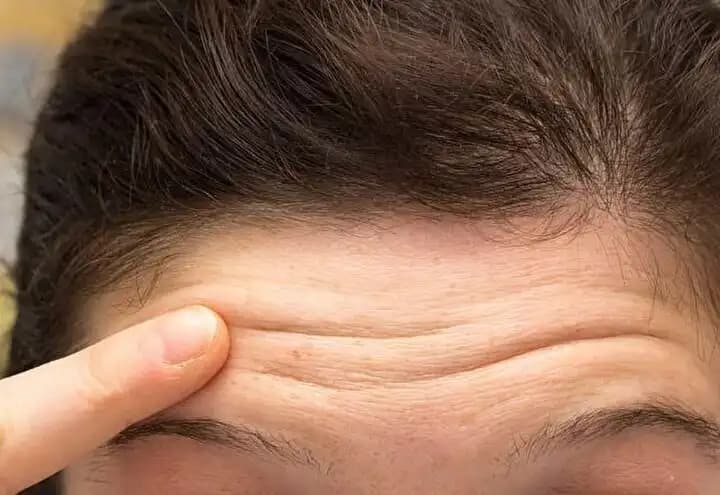 Alın Kırışıklıkları İçin Güncel Çözüm ve Koruma Yöntemleri Hakkında Bilgi
