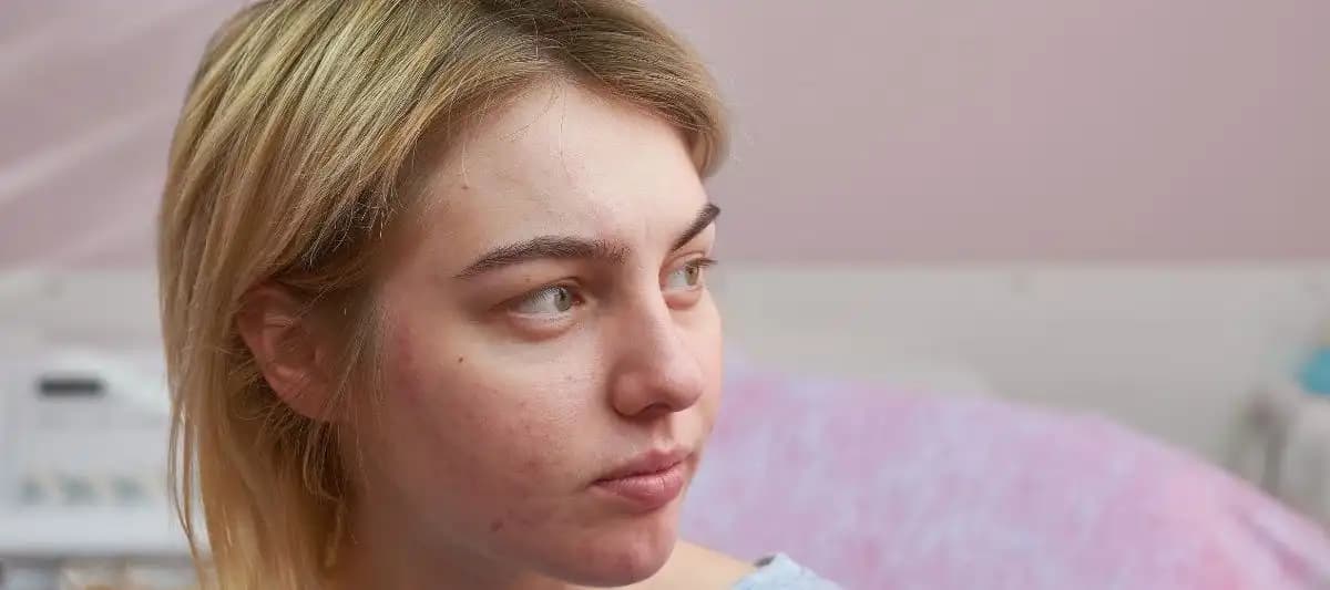 Alında Geçmeyen Sivilceler ve Etkili Çözüm Yöntemleri
