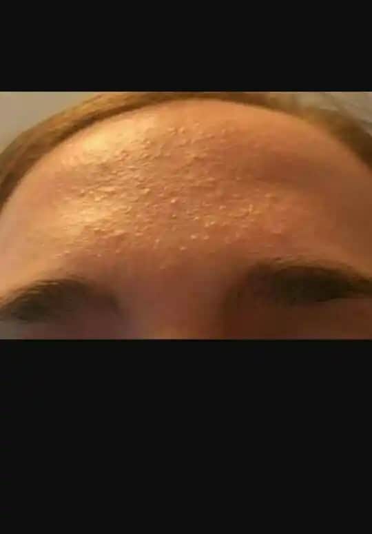 Alında Sivilce ve Isilik Arasındaki Farklar Nedenleri ve Etkili Çözüm Yolları