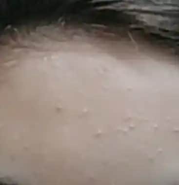 Alnınızdaki Küçük Sivilcelerin Nedenleri ve Etkili Çözüm Yöntemleri Hakkında Detaylı Bilgi