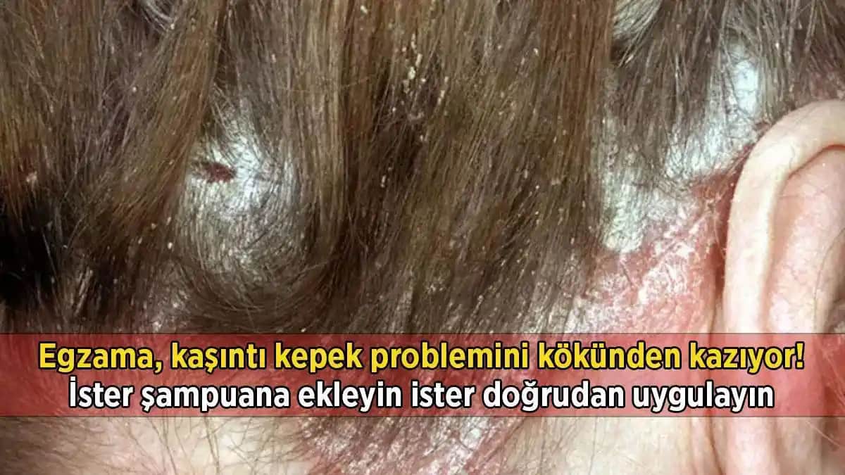 Aşırı Kepek ve Kaşıntı ile Mücadele Yolları Saç Sağlığını Koruma Rehberi