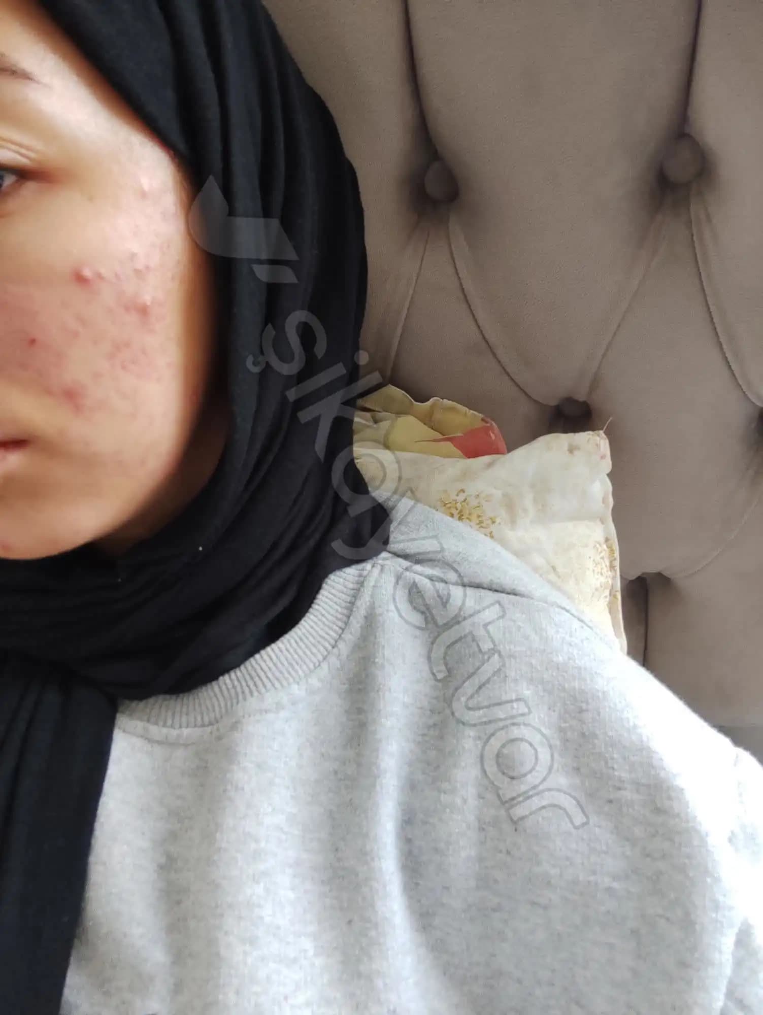 Aşırı Sivilcelenme ve Kozmetik Yaklaşımlar: Etkili Çözüm ve Bakım Yöntemleri