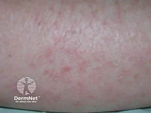 Asteatotik Egzama Nedir, Belirtileri ve Etkili Tedavi Yöntemleri