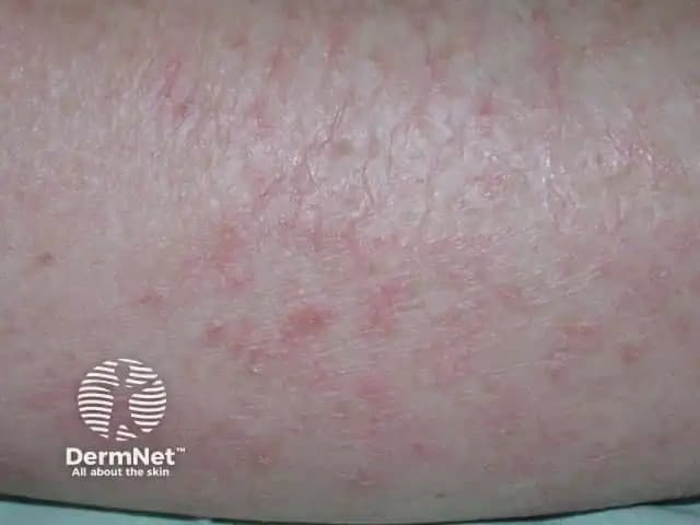 Asteatotik Egzama Nedir, Belirtileri ve Etkili Tedavi Yöntemleri