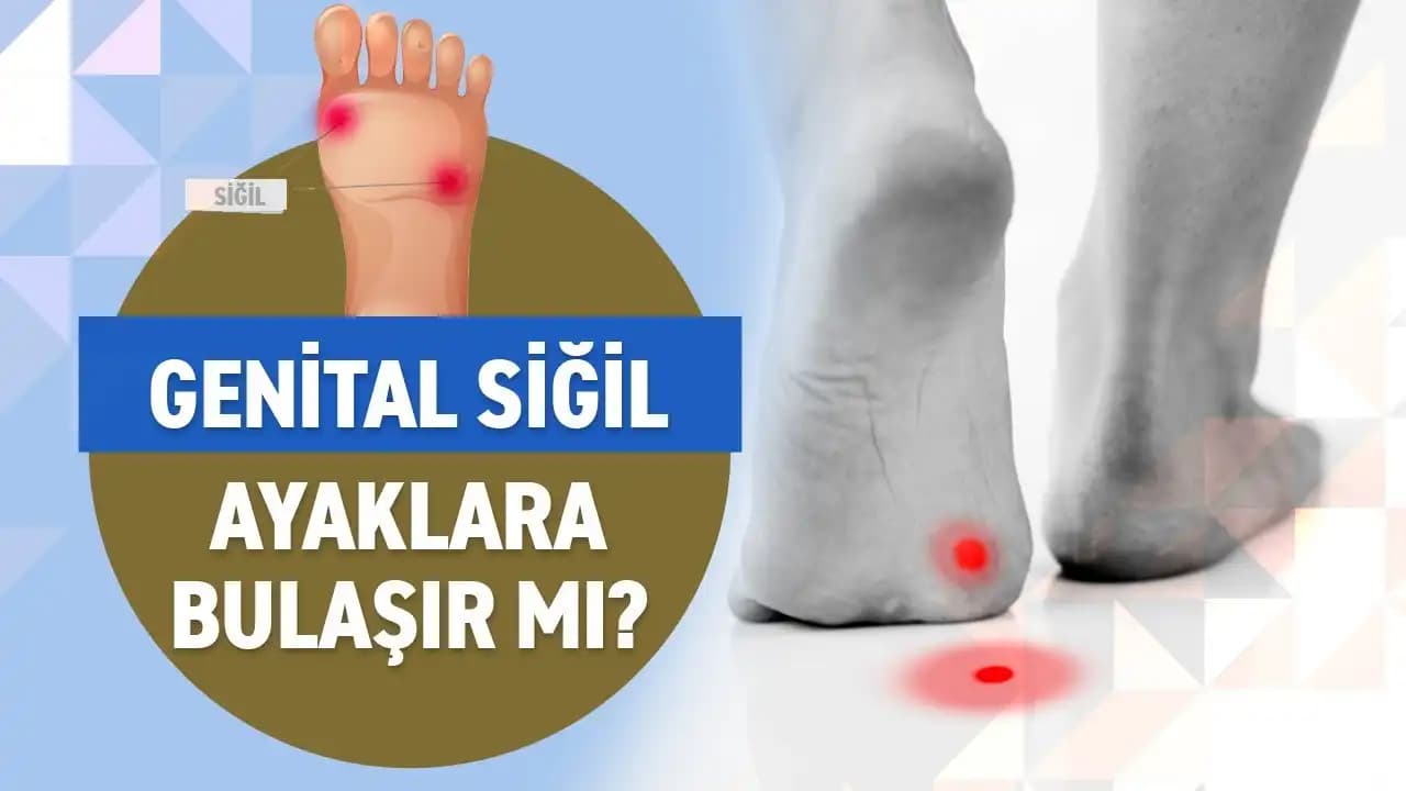 Ayak Altı Sivilceleri İçin Bilinçli Bakım ve Etkili Tedavi Yöntemleri