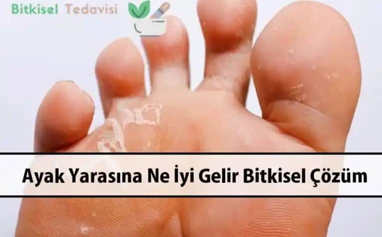 Ayak Altı Yaralarının Nedenleri ve Doğal Tedavi Yöntemleri Hakkında Bilgiler