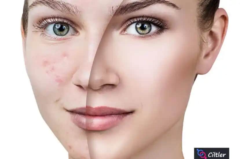 Ayak Altında Çıkan Sivilceler: Nedenleri, Tedavi ve Bakım Yöntemleri