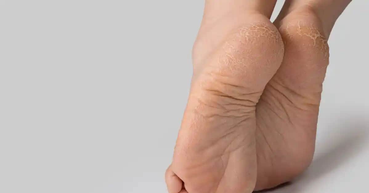 Ayak Çatlaması ve Kozmetik Yaklaşımlar: Sağlıklı ve Güzel Ayaklar İçin Rehber