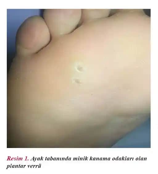 Ayak Tabanı Nasırları: Nedenleri, Kozmetik Etkileri ve Etkili Bakım Yöntemleri