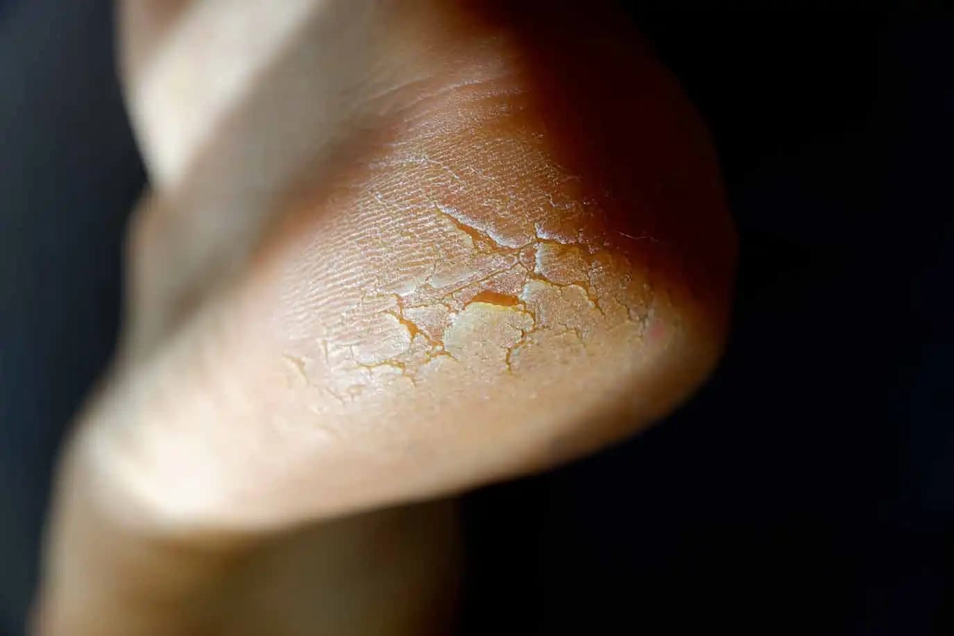 Ayak Topuğundaki Nasırın Kozmetik Yaklaşımlarla Tedavi ve Önleme Yöntemleri