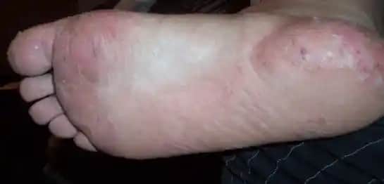 Ayaklarda Egzama Nedenleri, Belirtileri ve Etkili Bakım Yöntemleri