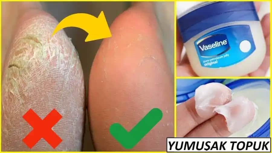 Ayaktaki Çatlaklara Karşı Etkili Bakım Yöntemleri ve Doğal Çözümler